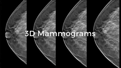 3d Tomosynthesis, 3d Mammograms .
